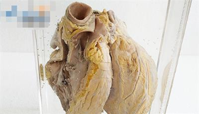 风湿性心脏病病理标本脂肪肝(肝脂肪变性)
