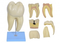磨牙蛀牙解剖放大模型  XM-911