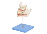 牙体病变模型 牙齿病变模型  XM-921
