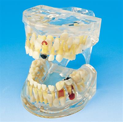 透明乳牙病理模型HK-L1006