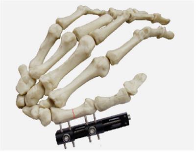 指掌骨骨折D型
