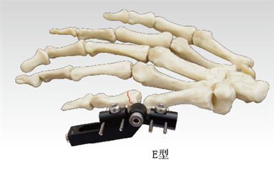指掌骨骨折(E型)10109