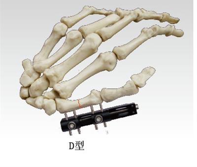 指掌骨骨折(D型)10109