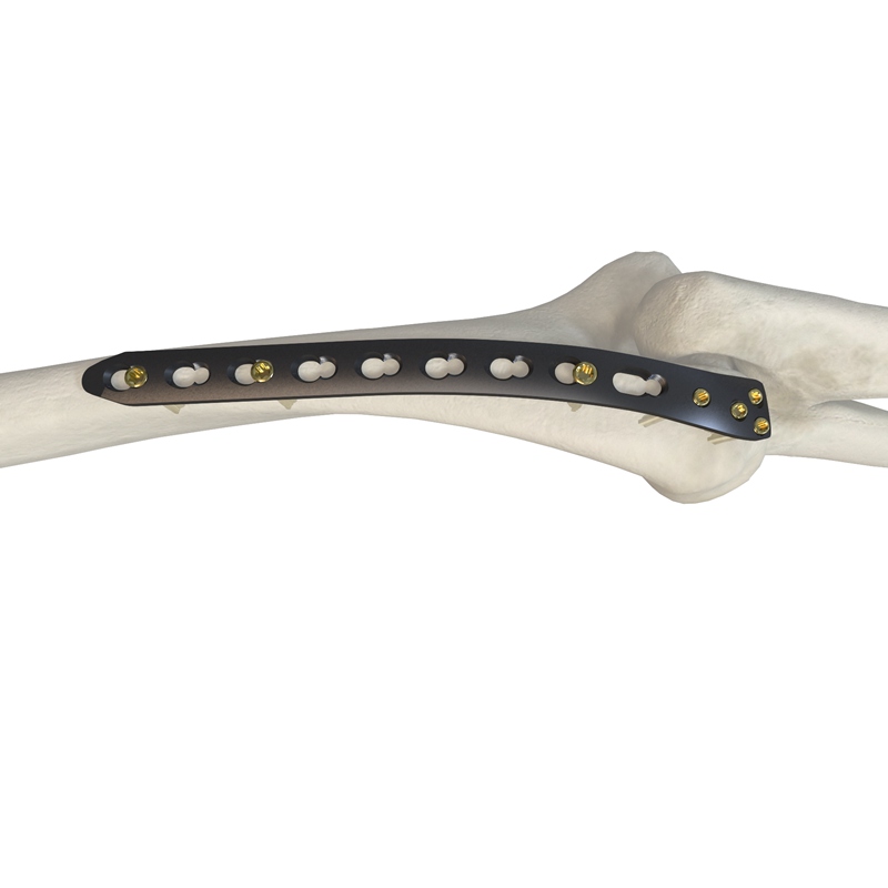 肱骨远端背外侧锁定接骨板I型 30719-109