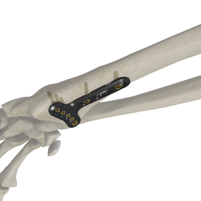桡骨远端掌侧关节外锁定接骨板（头5孔）10902-305