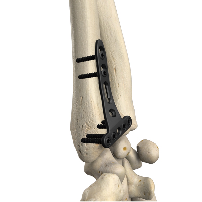 桡骨远端掌内侧锁定接骨板III型 10901-003