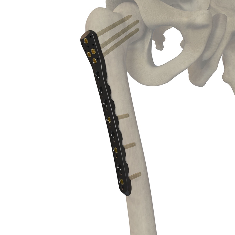股骨近端外侧锁定接骨板I型 30721-111