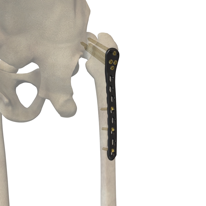 股骨近端外侧锁定接骨板II型 30716-005