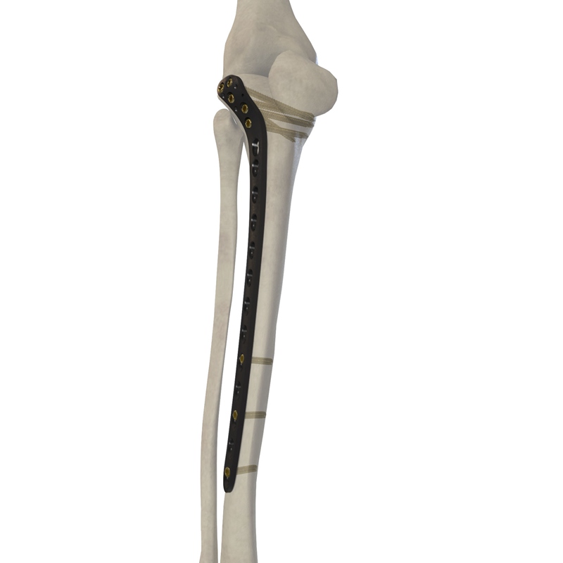 5.0mm胫骨近端外侧锁定接骨板 30723-005